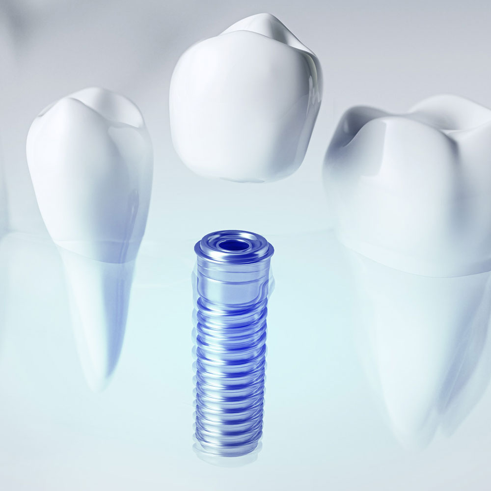 Implant nha khoa